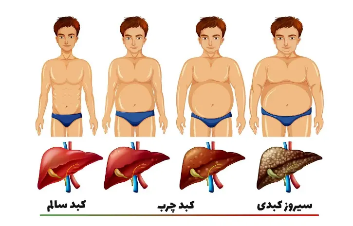 بیماری کبد چرب